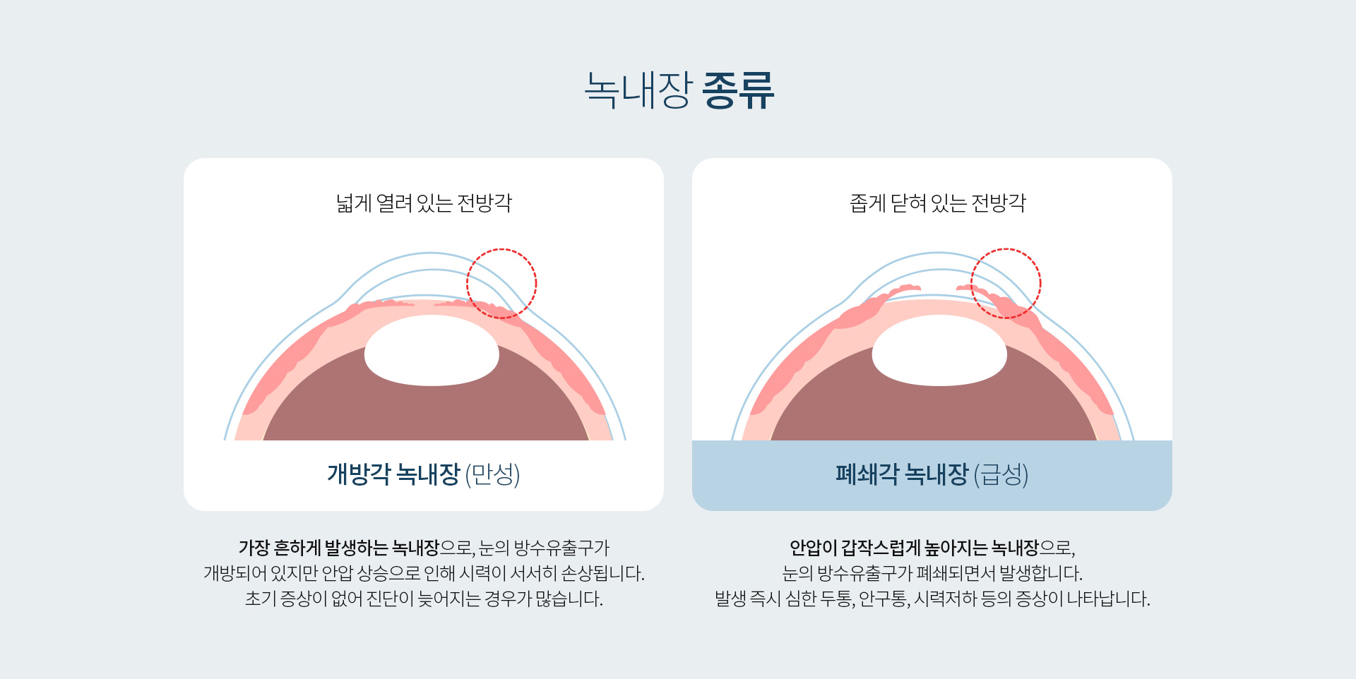 녹내장_02