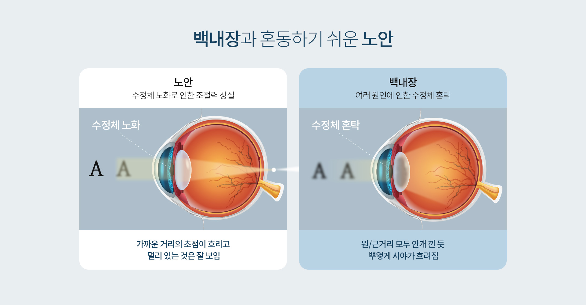 노안_03