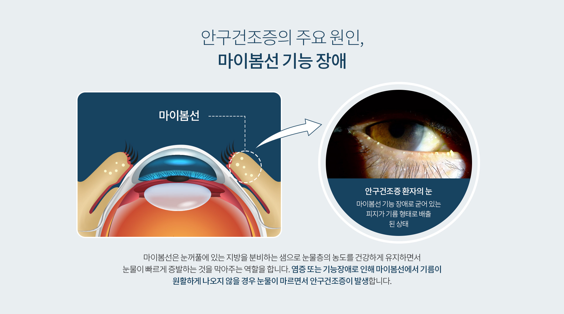 안구건조증_02