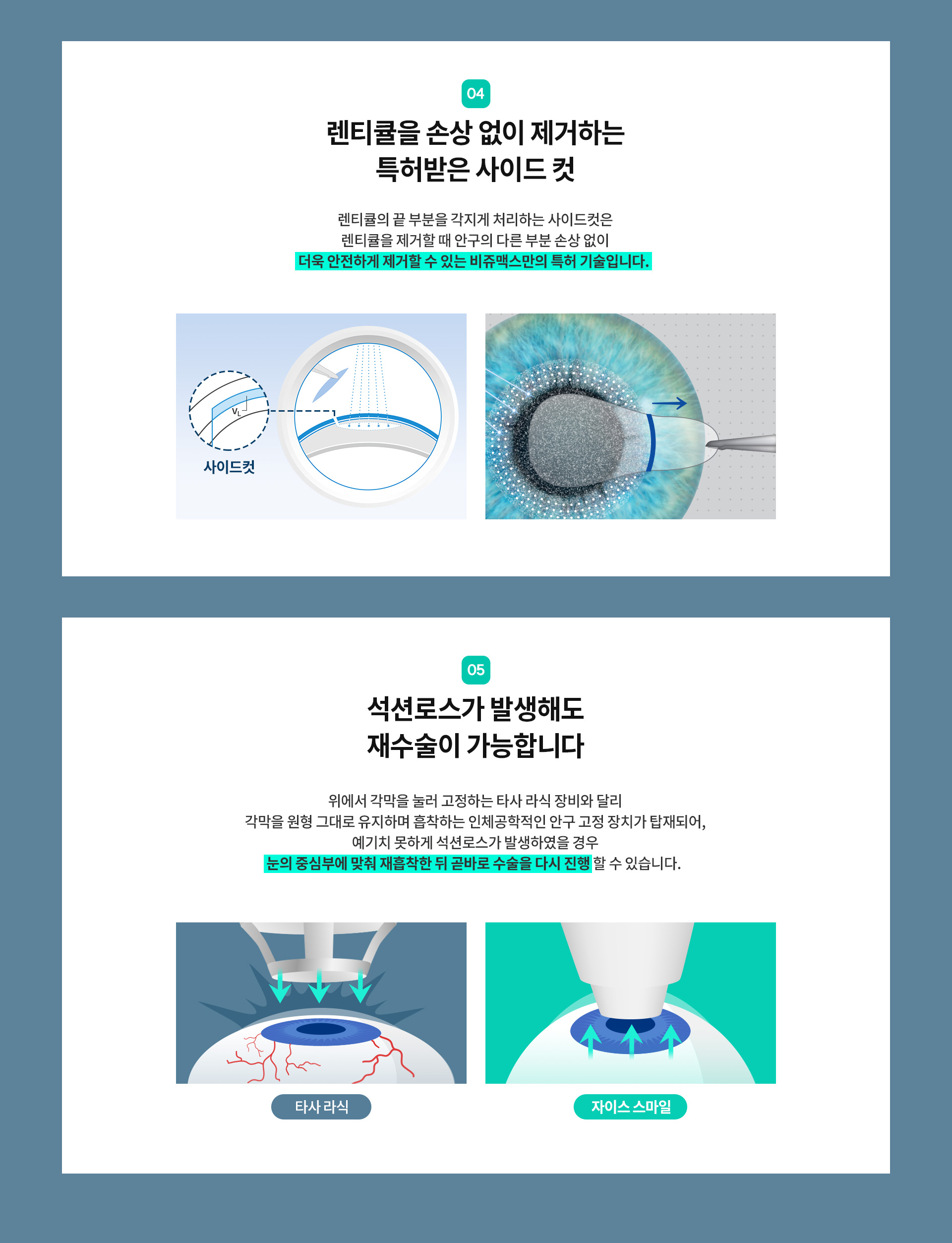 자이스 스마일®_06